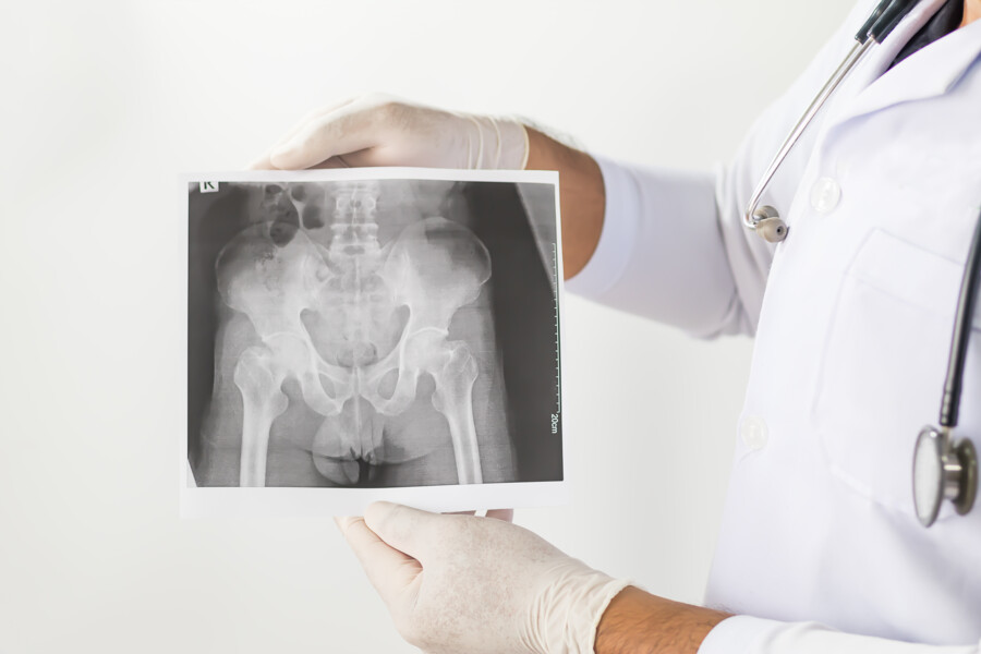 Bechtěrevova choroba