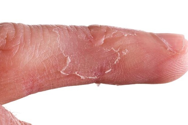 Dermatitida