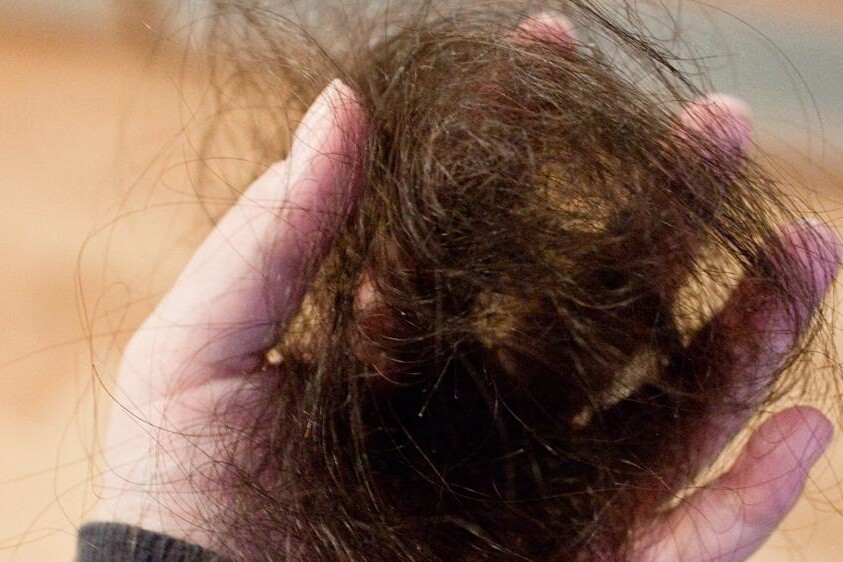 Alopecie u dětí
