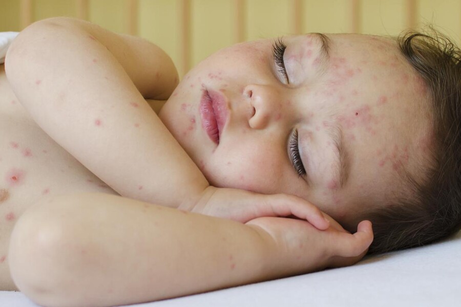 Multiformní erytém u dětí