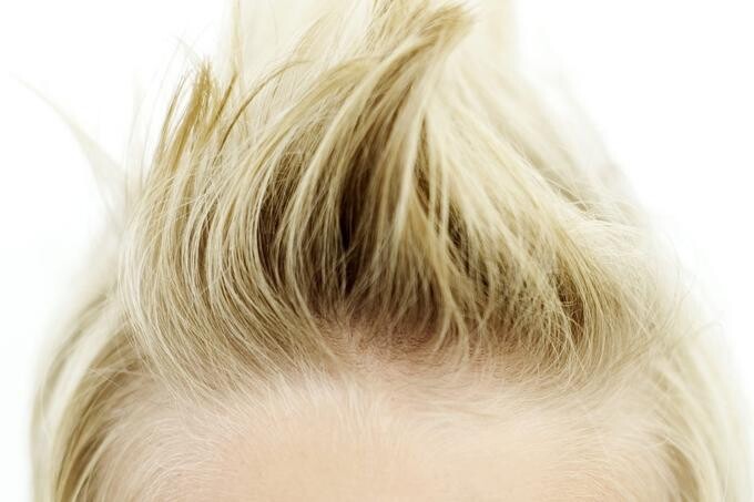Zánět pokožky ve vlasové části hlavy u dětí