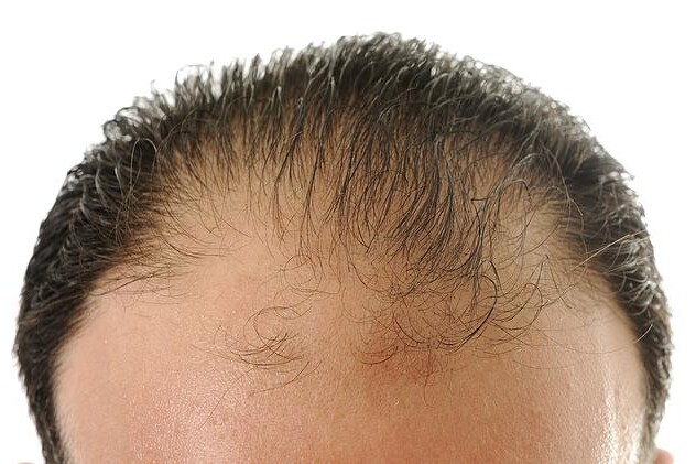 Vypadávání vlasů