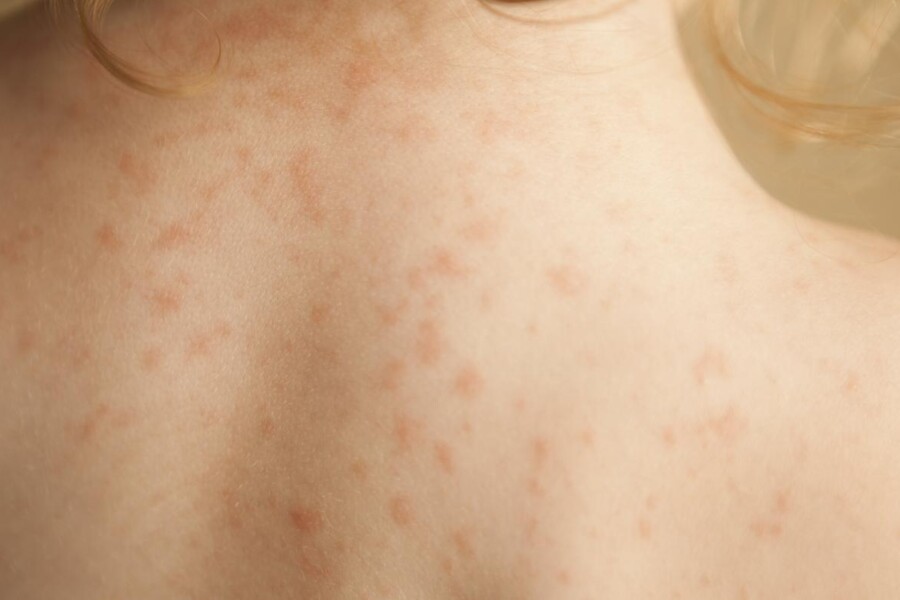 Seboroická dermatitida