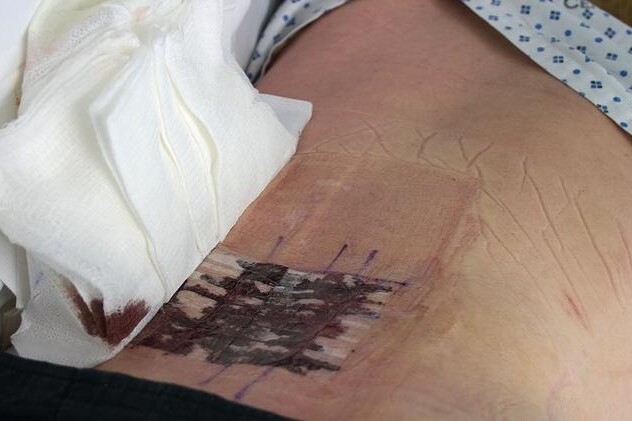 Bércové vředy - léčba