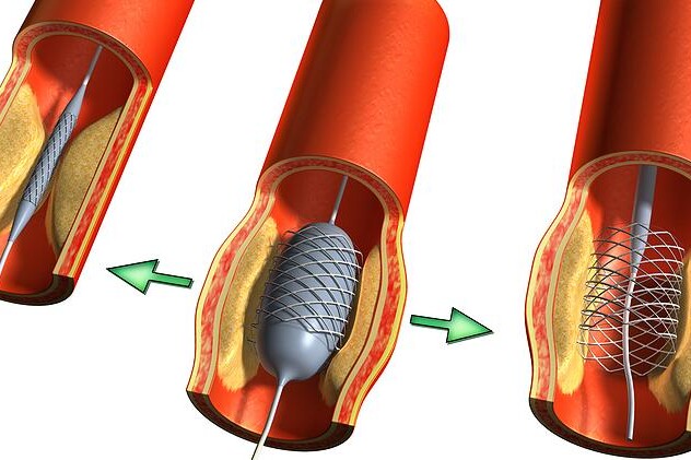 Léčba infarktu myokardu
