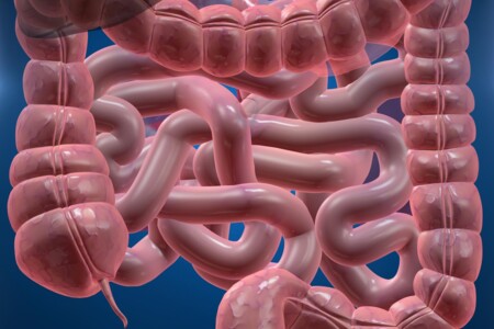 Meckelův divertikl u dětí