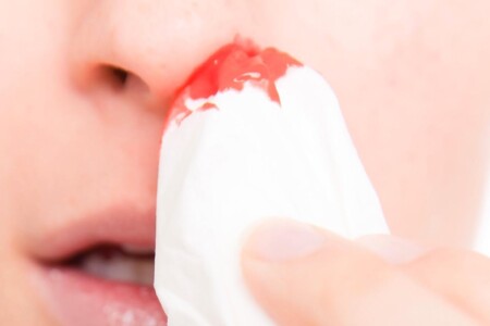 První pomoc při krvácení z nosu u dětí