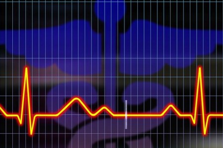 Bradykardie - zpomalení srdečního rytmu