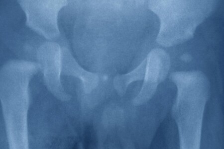 Kostální chondritida