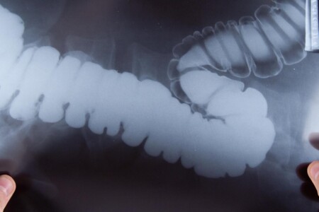 Hirschsprungova nemoc