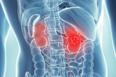 Wilmsův tumor u dětí