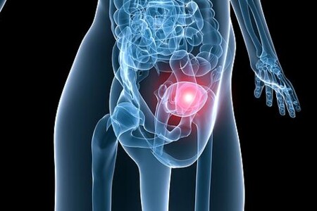 Zánět a rakovina vulvy