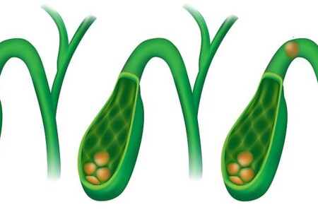 Žlučníkové kameny