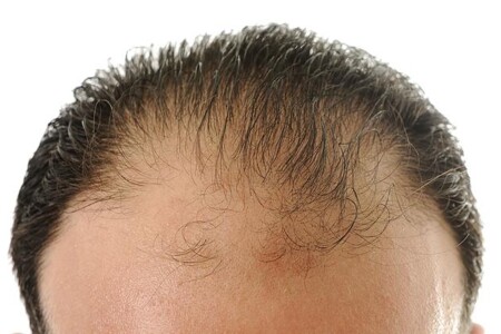 Vypadávání vlasů