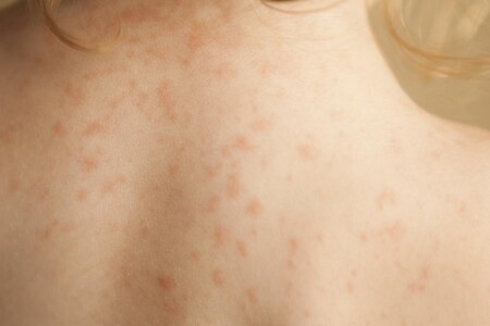 Seboroická dermatitida