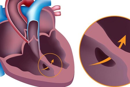 Vrozené srdeční vady