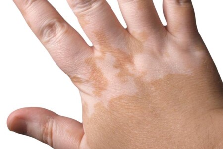 Vitiligo u dětí
