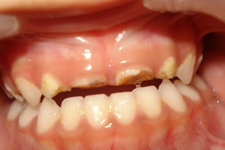 Stav chrupu dětí je alarmující