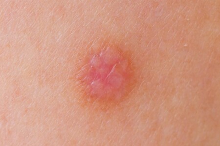 Genitální bradavice