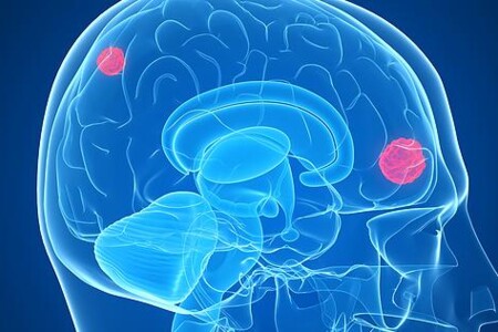 Astrocytom, ependymom a oligodendrogliom 