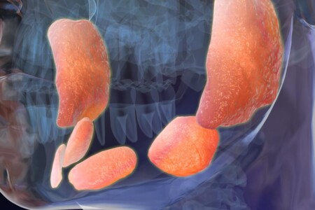 Příušnice u dětí